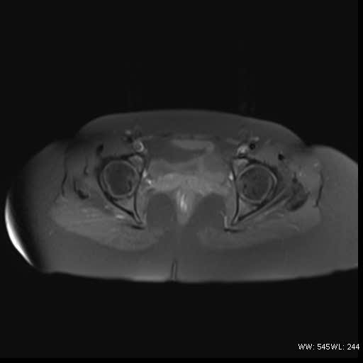 File:Bicornuate uterus- on MRI (Radiopaedia 49206-54297 Axial T1 fat sat 15).jpg