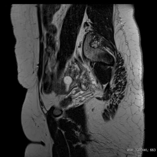 File:Bicornuate uterus- on MRI (Radiopaedia 49206-54297 Sagittal T2 5).jpg