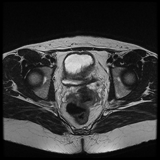 File:Bicornuate uterus (Radiopaedia 51676-57472 Axial T2 15).jpg