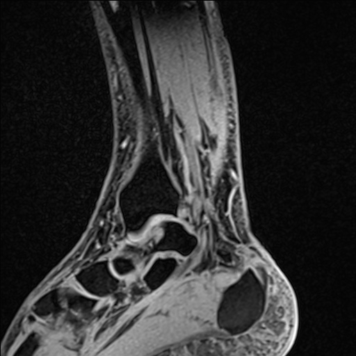 File:Bilateral Achilles tendon complete tear (Radiopaedia 81344-95051 Sagittal WE - Left 43).jpg