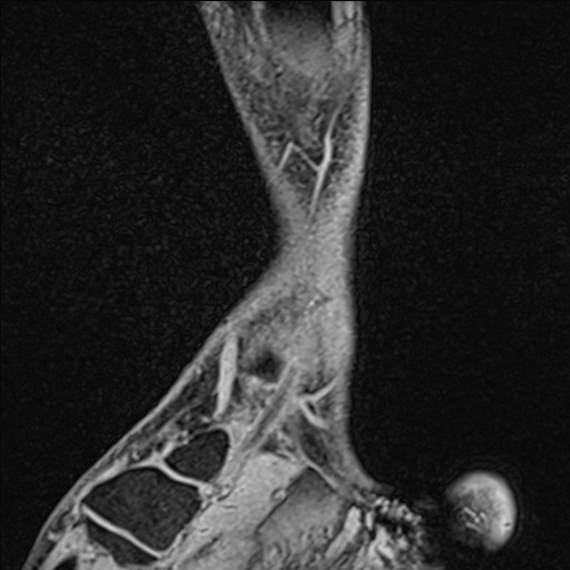 Bilateral Achilles tendon complete tear (Radiopaedia 81344-95051 Sagittal WE - Right 90).jpg