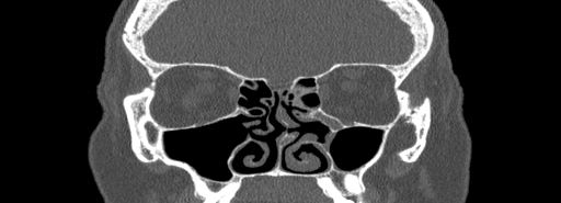 Bilateral Ectopic Infraorbital Nerves (Radiopaedia 49006-54084 Coronal bone window 32).jpg