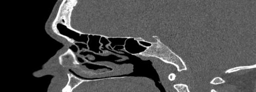 File:Bilateral Ectopic Infraorbital Nerves (Radiopaedia 49006-54084 Sagittal bone window 23).jpg