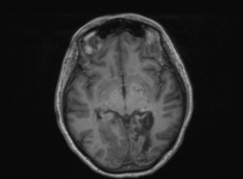 File:Bilateral PCA territory infarction - different ages (Radiopaedia 46200-51784 Axial T1 251).jpg
