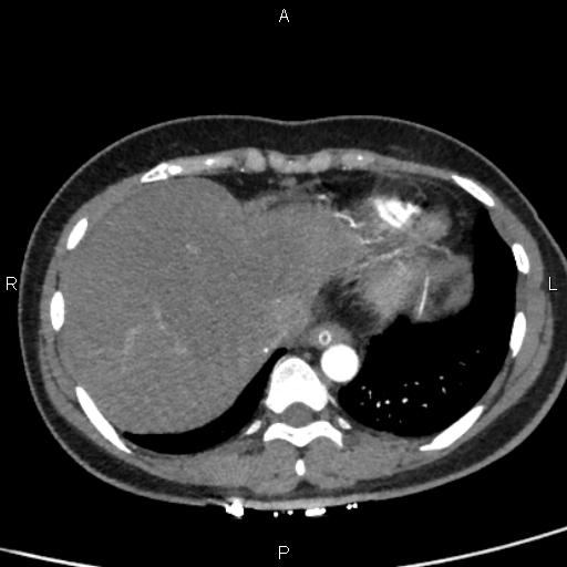 Bilateral adrenal gland hyperenhancement in pancreatitis (Radiopaedia 86642-102753 B 12).jpg
