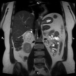 File:Bilateral adrenal myelolipoma (Radiopaedia 63058-71537 Coronal T2 15).jpg
