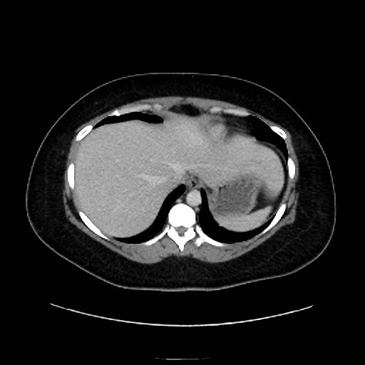 Bilateral adrenal thrombosis (Radiopaedia 58182-65256 A 7).jpg
