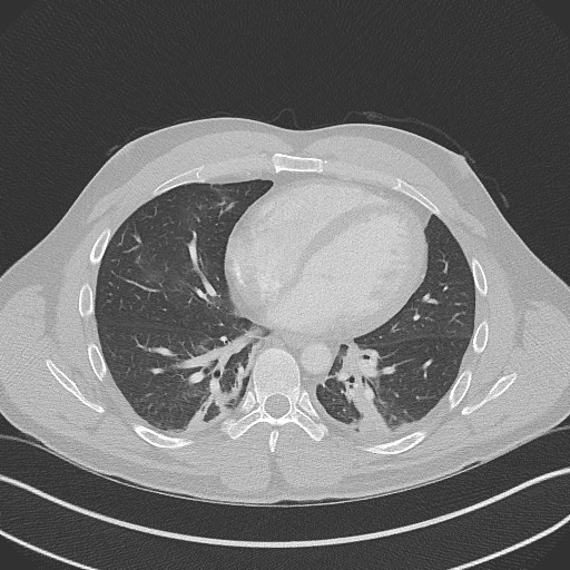 Bilateral atelectasis (Radiopaedia 48666-53675 Axial lung window 72).jpg