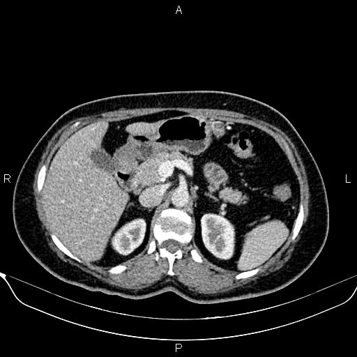 Bilateral benign adrenal adenomas (Radiopaedia 86912-103124 B 36).jpg