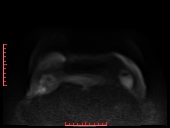 File:Bilateral breast implant rupture (Radiopaedia 24761-25027 DWI 30).jpg