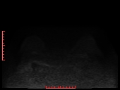 File:Bilateral breast implant rupture (Radiopaedia 24761-25027 DWI 8).jpg