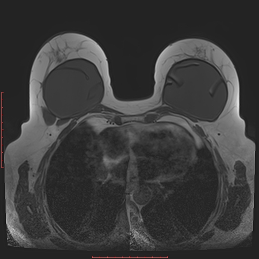 File:Bilateral breast implant rupture (Radiopaedia 24761-25027 T1 21).jpg