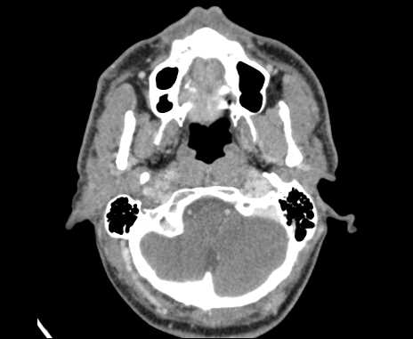 Bilateral carotid body tumors (Radiopaedia 61841-69870 Axial Post contrast 12).jpg