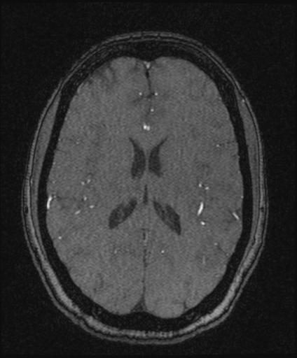 Bilateral carotid body tumors and right glomus jugulare tumor (Radiopaedia 20024-20060 Axial MRA 113).jpg