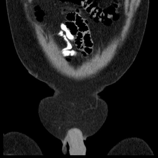 File:Bilateral direct inguinal herniae (Radiopaedia 17016-16719 A 2).jpg