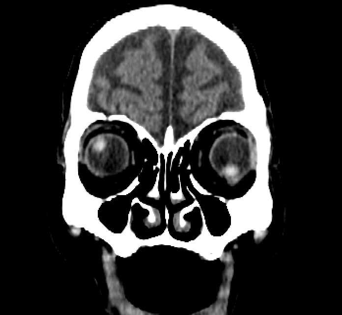 Bilateral ectopia lentis (Radiopaedia 89889-107013 Coronal non-contrast 43).jpg