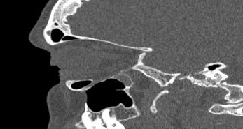 File:Bilateral ectopic infraorbital nerves (Radiopaedia 49006-54084 Sagittal 23).png