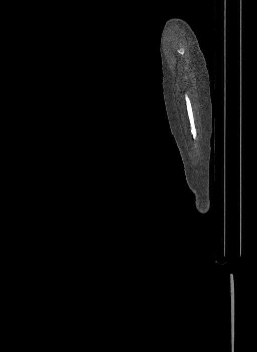 Bilateral fibular hemimelia type II (Radiopaedia 69581-79491 Sagittal bone window 74).jpg