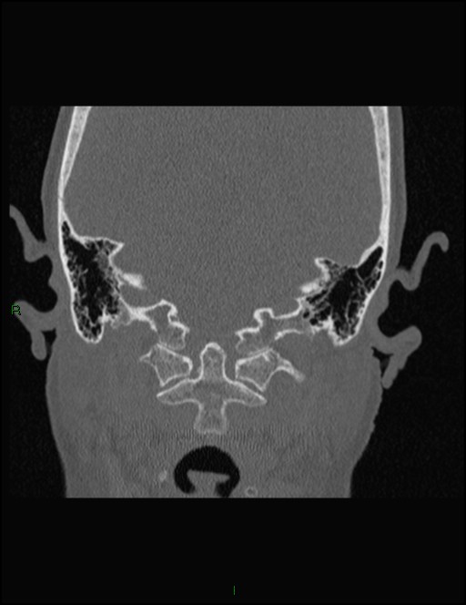 Bilateral frontal mucoceles (Radiopaedia 82352-96454 Coronal 337).jpg