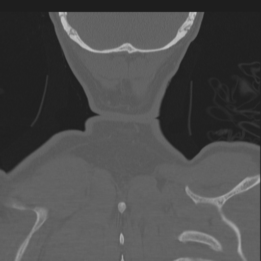 Bilateral locked facets (Radiopaedia 33850-35016 Coronal bone window 87).png
