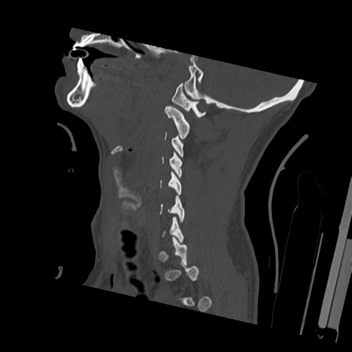 Bilateral locked facets (Radiopaedia 33850-35023 Sagittal bone window 42).png