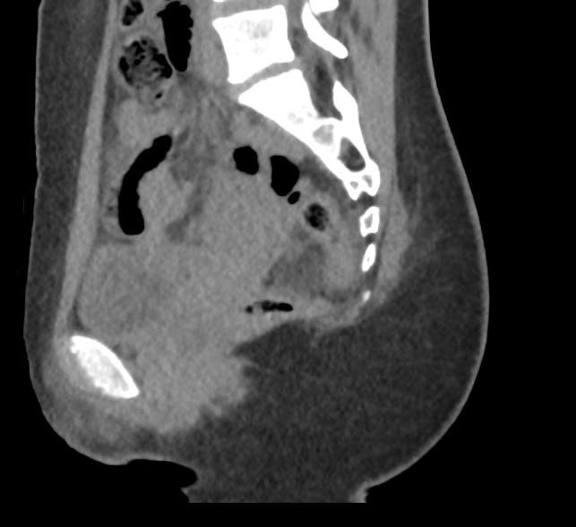 Bilateral mature cystic ovarian teratoma (Radiopaedia 88821-105592 D 27).jpg