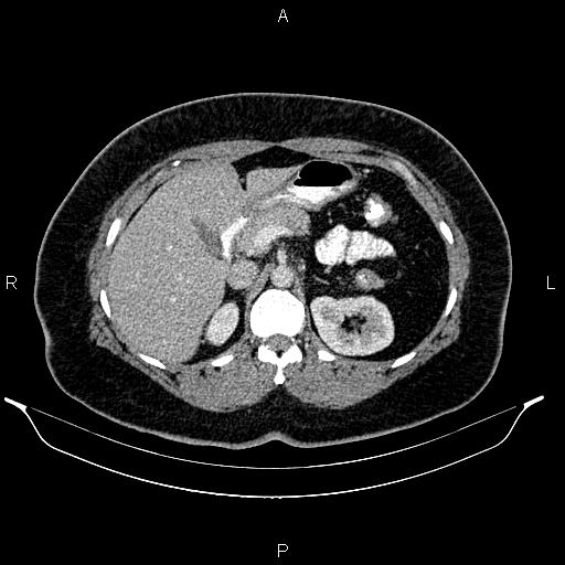 File:Bilateral ovarian dermoid cysts (Radiopaedia 85785-101603 A 37).jpg