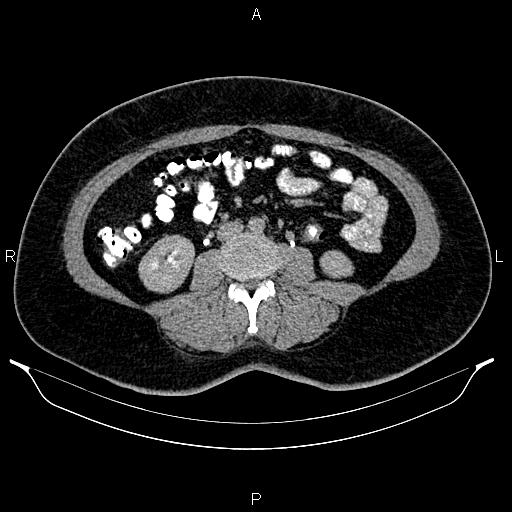 Bilateral ovarian dermoid cysts (Radiopaedia 85785-101603 Axial C+ delayed 39).jpg