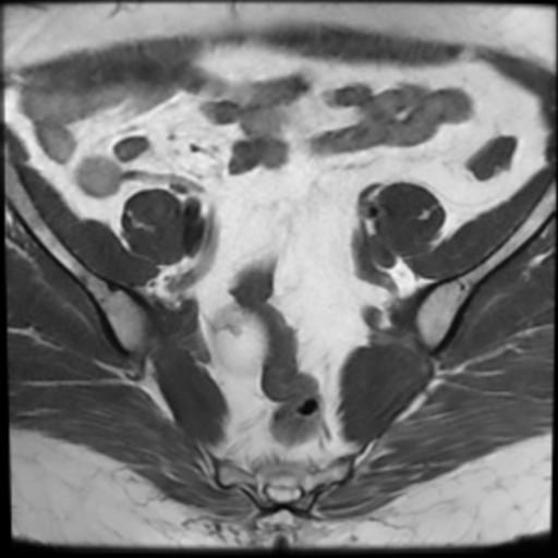 File:Bilateral ovarian dermoid cysts (Radiopaedia 90152-107338 Axial T1 7).jpg