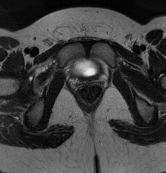File:Bilateral ovarian fibrothecomas - adolescent (Radiopaedia 86604-102707 Axial T2 41).jpg