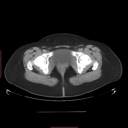 File:Bilateral ovarian serous cystadenocarcinoma with right ovarian torsion (Radiopaedia 32640-33611 A 42).jpg