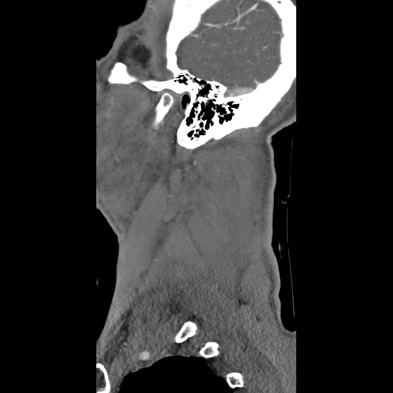 Bilateral perched facets with cord injury (Radiopaedia 45587-49713 B 52).jpg