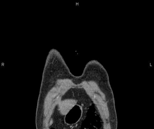 Bilateral pulmonary AVM (Radiopaedia 83134-97505 C 3).jpg