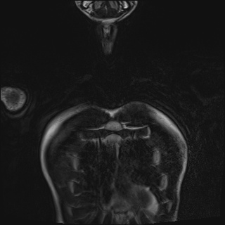 File:Bilateral spinoglenoid notch ganglion cysts (Radiopaedia 29577-30082 Coronal T2 6).jpg