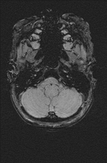 Bilateral subdural hemorrhage and parietal skull fracture (Radiopaedia 26058-26190 Axial SWI 9).png