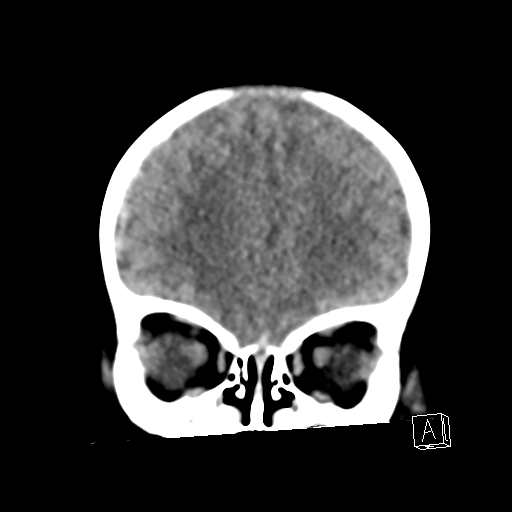 File:Bilateral subdural hemorrhage and parietal skull fracture (Radiopaedia 26058-26192 Coronal non-contrast 6).png