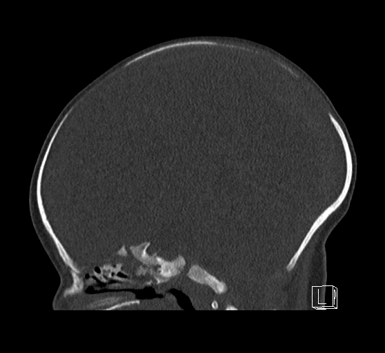 Bilateral subdural hemorrhage and parietal skull fracture (Radiopaedia 26058-26192 Sagittal bone window 44).png