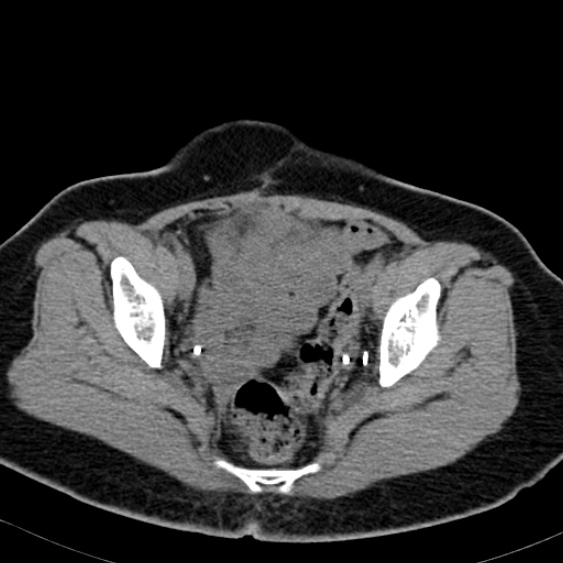 File:Bilateral ureteric stents (Radiopaedia 48795-53825 Axial non-contrast 58).jpg