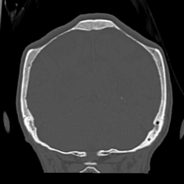 Biparietal osteodystrophy (Radiopaedia 46109-50463 Coronal bone window 80).jpg
