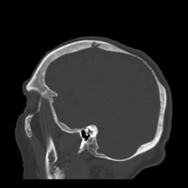 Biparietal osteodystrophy (Radiopaedia 46109-50463 Sagittal bone window 28).jpg