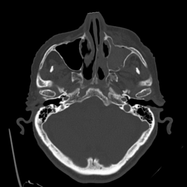 Biparietal osteodystrophy (Radiopaedia 46109-50463 bone window 17).jpg