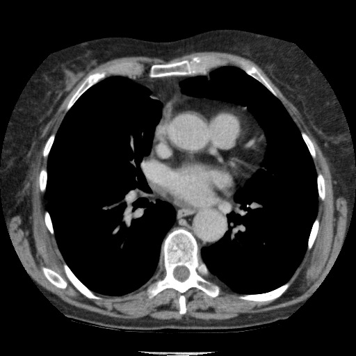 Bladder tumor detected on trauma CT (Radiopaedia 51809-57609 C 3).jpg
