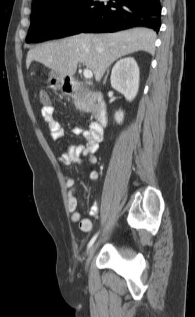 Bleeding duodenal ulcer and adenomyomatosis of gallbladder (Radiopaedia 61834-69861 C 36).jpg