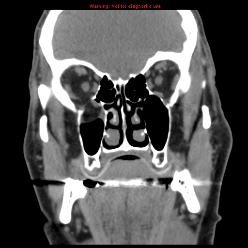 File:Blowout fracture with inferior rectus entrapment (Radiopaedia 12418-12673 Coronal non-contrast 14).jpg