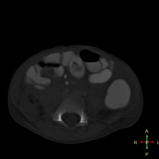File:Blunt abdominal trauma (Radiopaedia 24780-25044 Axial bone window 3).jpg