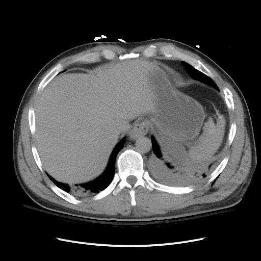 Blunt abdominal trauma with solid organ and musculoskelatal injury with active extravasation (Radiopaedia 68364-77895 Axial C+ delayed 23).jpg