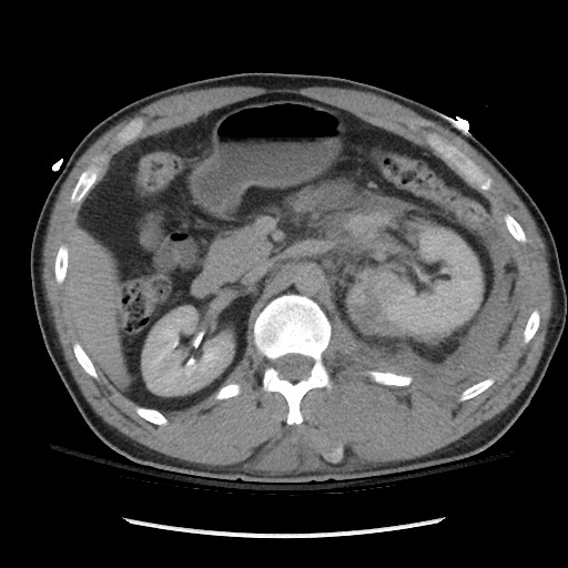 Blunt abdominal trauma with solid organ and musculoskelatal injury with active extravasation (Radiopaedia 68364-77895 Axial C+ delayed 51).jpg
