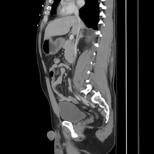 Blunt abdominal trauma with solid organ and musculoskelatal injury with active extravasation (Radiopaedia 68364-77895 C 66).jpg