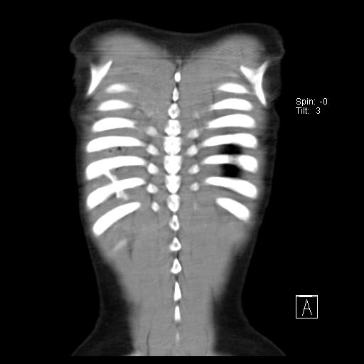File:Bochdalek diaphragmatic hernia (Radiopaedia 38866-41059 Coronal liver window 20).jpg
