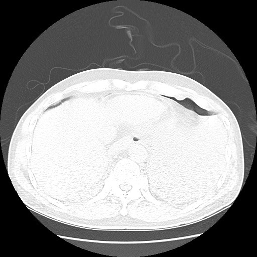 Boerhaave syndrome (Radiopaedia 59796-67310 Axial lung window 51).jpg